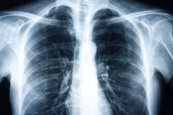 Pneumonia