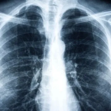 Pneumonia