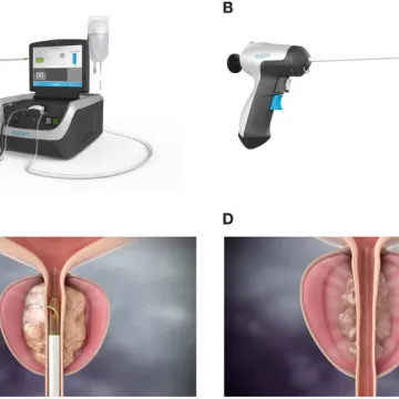 Prostate cancer