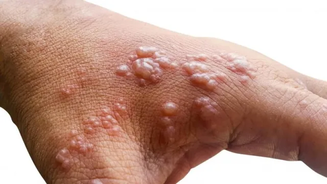 monkeypox monkeypox