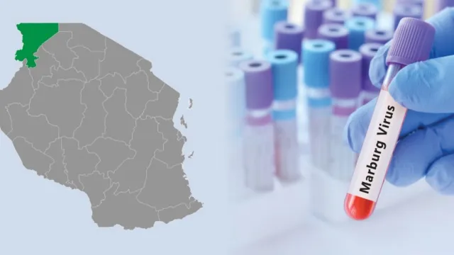 Marburg virus disease (MVD) reported in Tanzania.