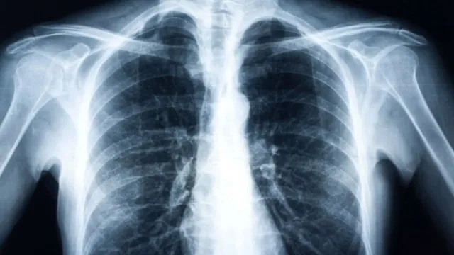 Pneumonia