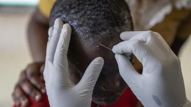 Mpox Kenya