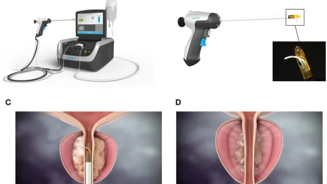 Prostate cancer